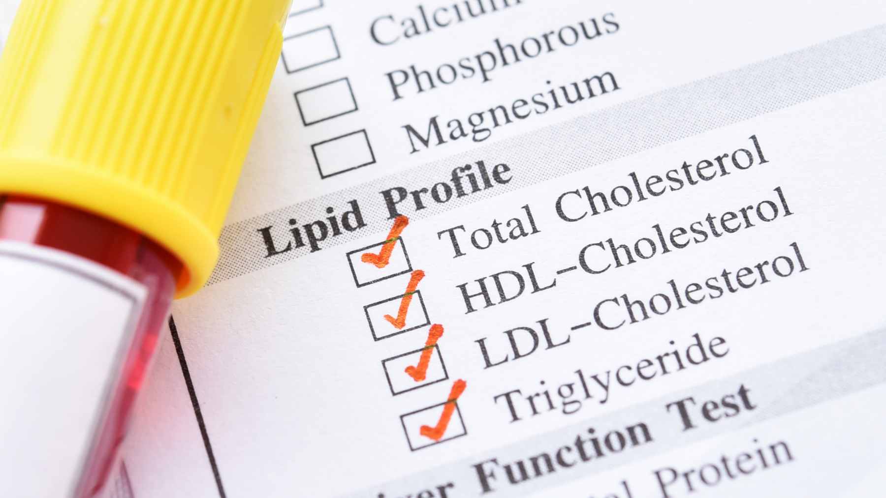 A medical laboratory blood sample being analyzed for lipid panels and apolipoprotein B levels to assess cardiovascular health.
