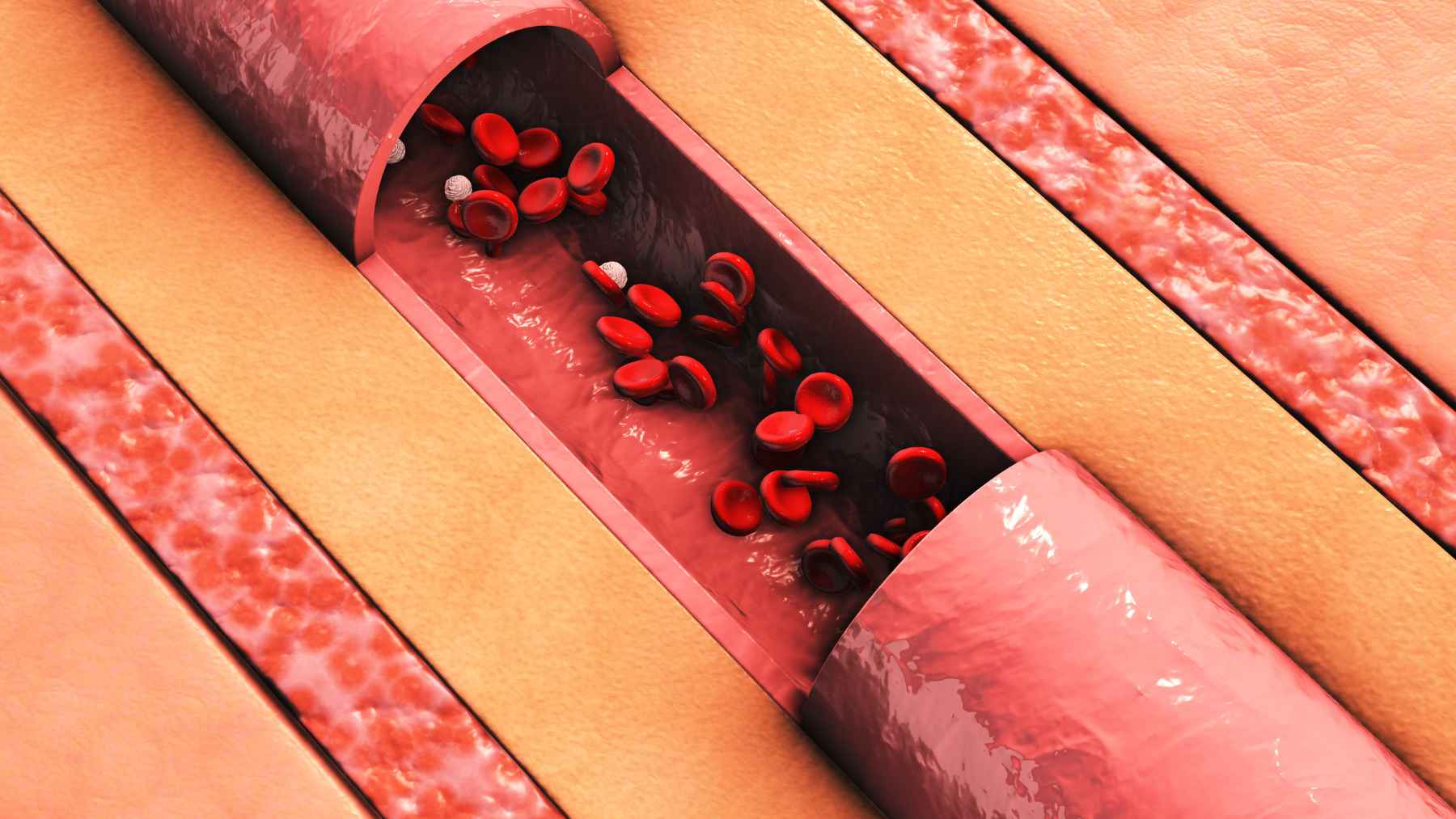 Illustration of microscopic blood clots inside a small blood vessel, representing microthrombi linked to Alzheimer's disease and reduced brain blood flow.