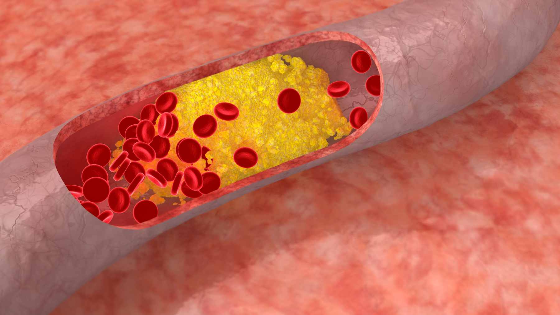 Heart disease from high cholesterol still kills more people than anything, and researchers say a breakthrough against stubborn LDL may finally be near 2 A medical illustration showing a liver cell surface with LDL receptors capturing cholesterol molecules from the bloodstream.