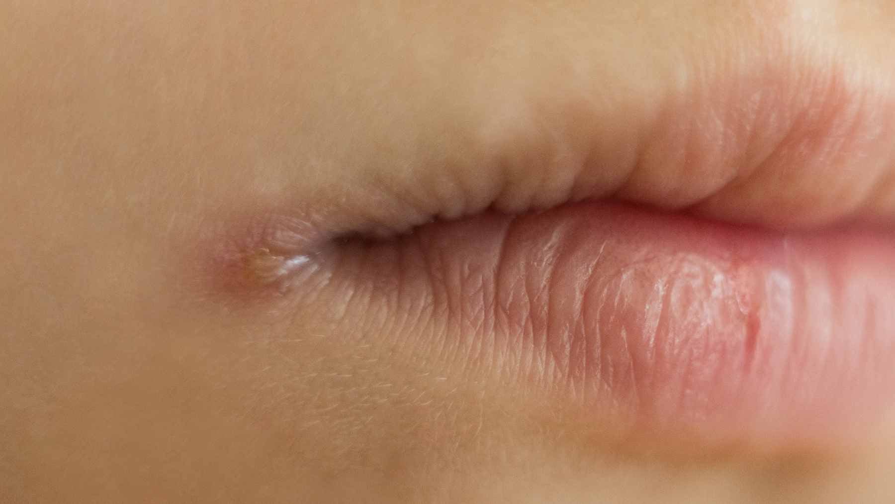 Close-up of a person with angular cheilitis, showing the characteristic inflammation and cracking at the corner of the mouth.