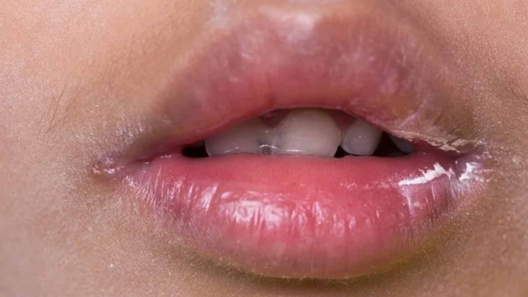 Cracked corners of your mouth aren't random, they often point to a B-vitamin gap, and the everyday foods that fix it may surprise you 2 Close-up of a person with angular cheilitis, showing the characteristic inflammation and cracking at the corner of the mouth.