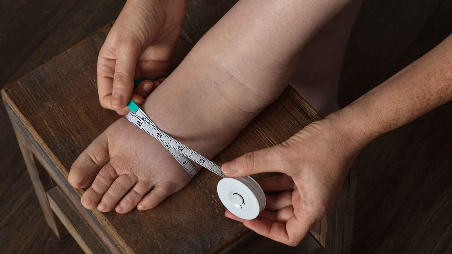 Not every supplement eases lymphedema; doctors say only a couple of vitamins have real evidence, the rest may just waste your money 1 Healthcare professional measures arm swelling in a patient with lymphedema using a tape measure during a clinical evaluation.