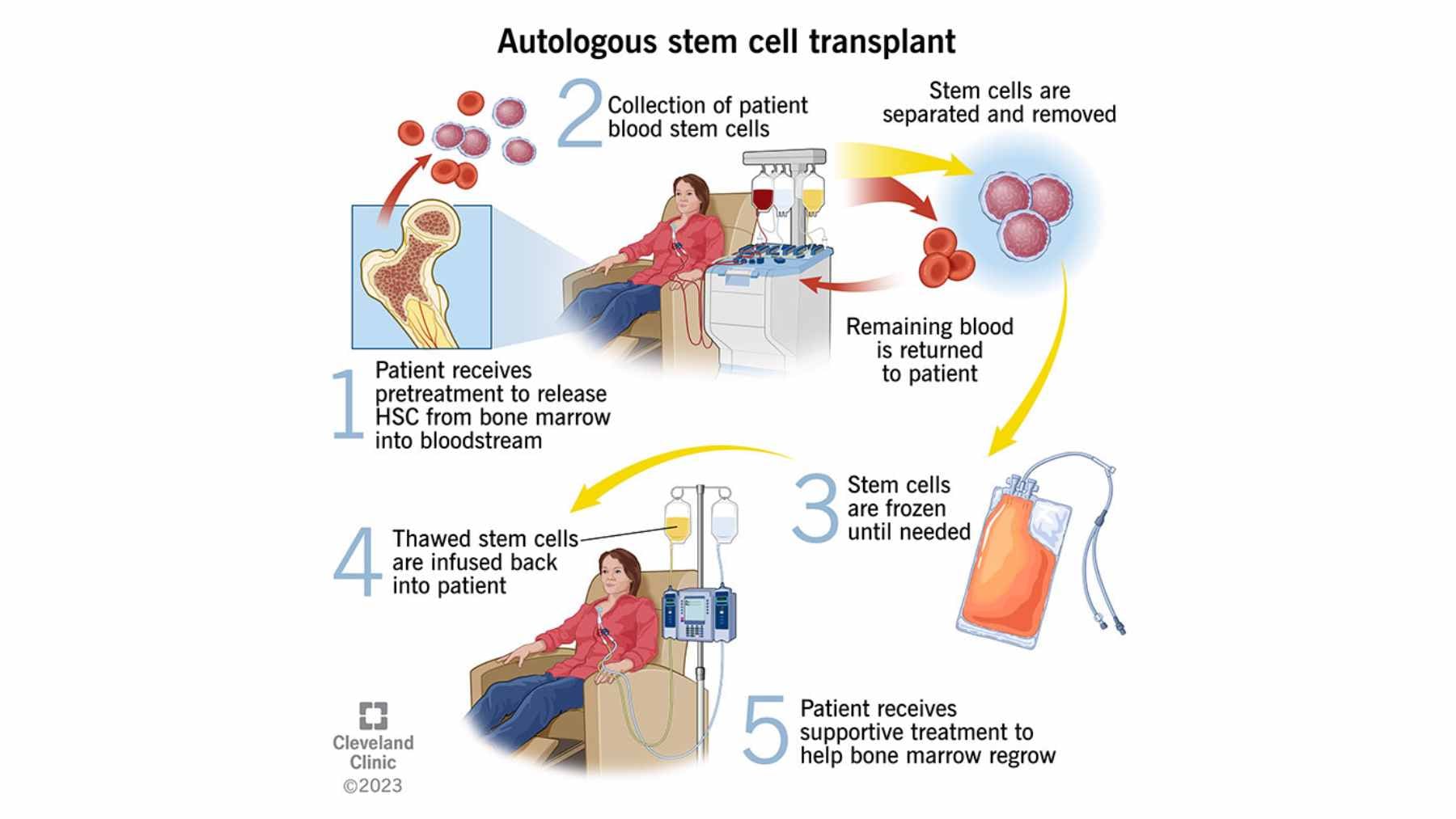 A medical researcher examining neural imaging and antibody reports during a long-term clinical study on autoimmune stem cell treatments.