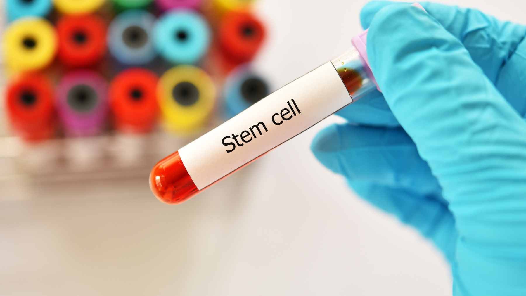 A medical researcher examining neural imaging and antibody reports during a long-term clinical study on autoimmune stem cell treatments.