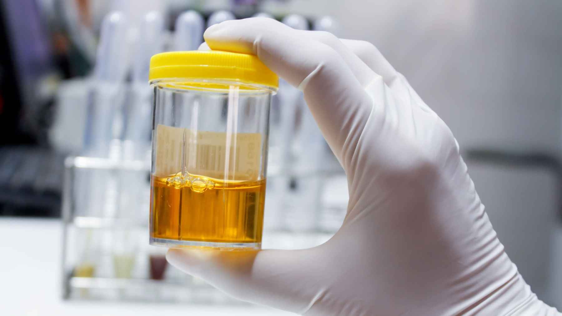 Urine sample showing its yellow color, illustrating how hydration, diet, and certain health conditions can affect urine appearance.