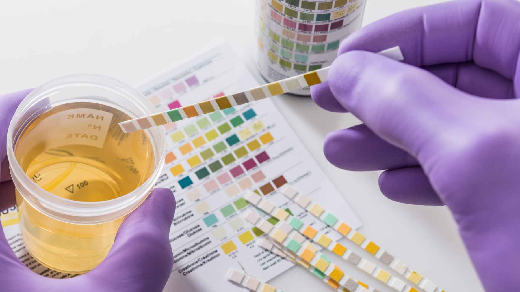 The color of your urine reveals more about your hydration and diet than you think, yet one shade in particular is a quiet warning 1 Healthcare professional comparing a urine sample with a color test strip to assess hydration levels and identify possible health concerns.