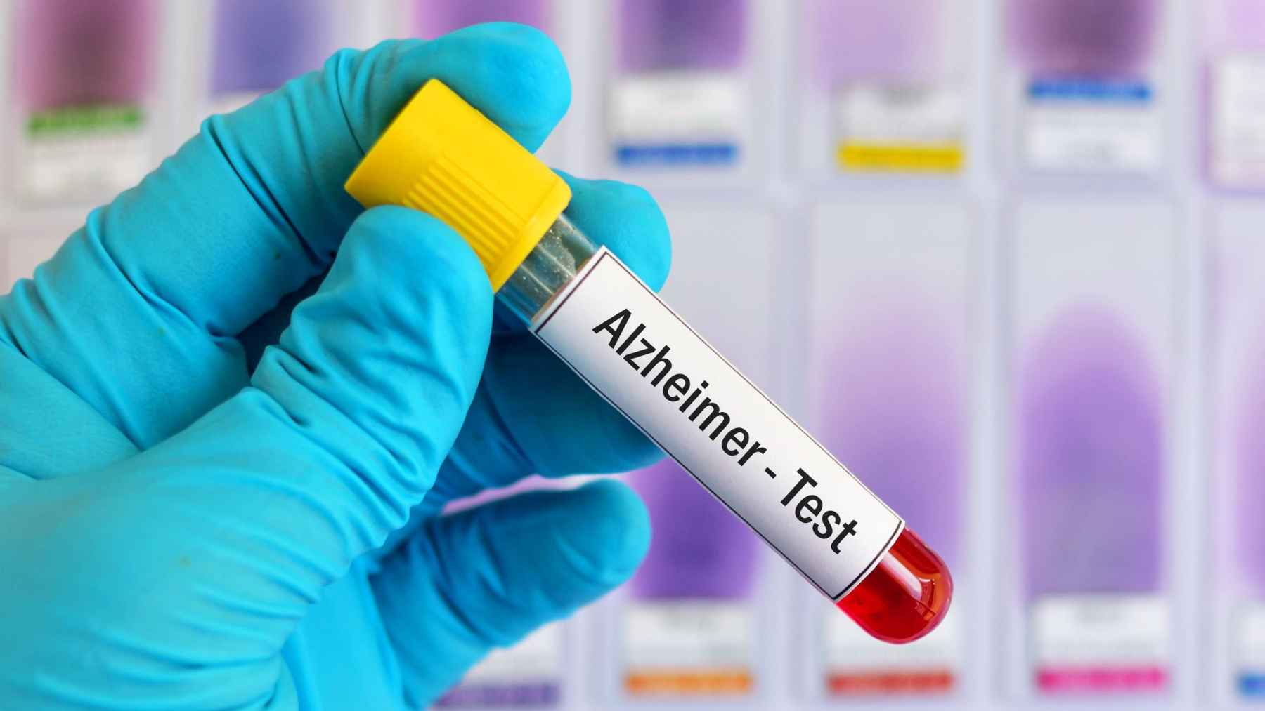 That new Alzheimer blood test isn't a clean bill of health for healthy people, and doctors are warning why you might want to wait 1 A laboratory technician holds a blood sample labeled Alzheimer's Test, illustrating research into p-tau217 biomarkers for cognitive decline risk.