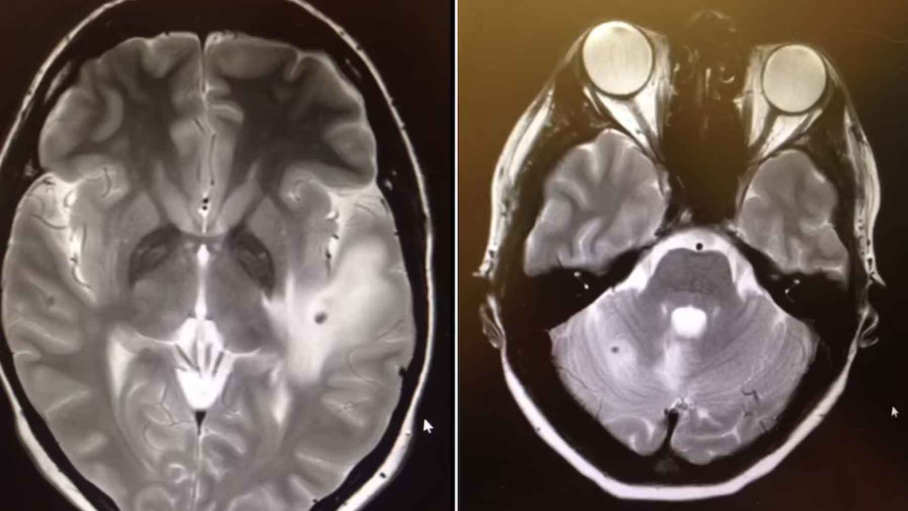 MRI scans showing multiple parasitic cysts in the brain caused by neurocysticercosis, a tapeworm infection affecting the central nervous system.