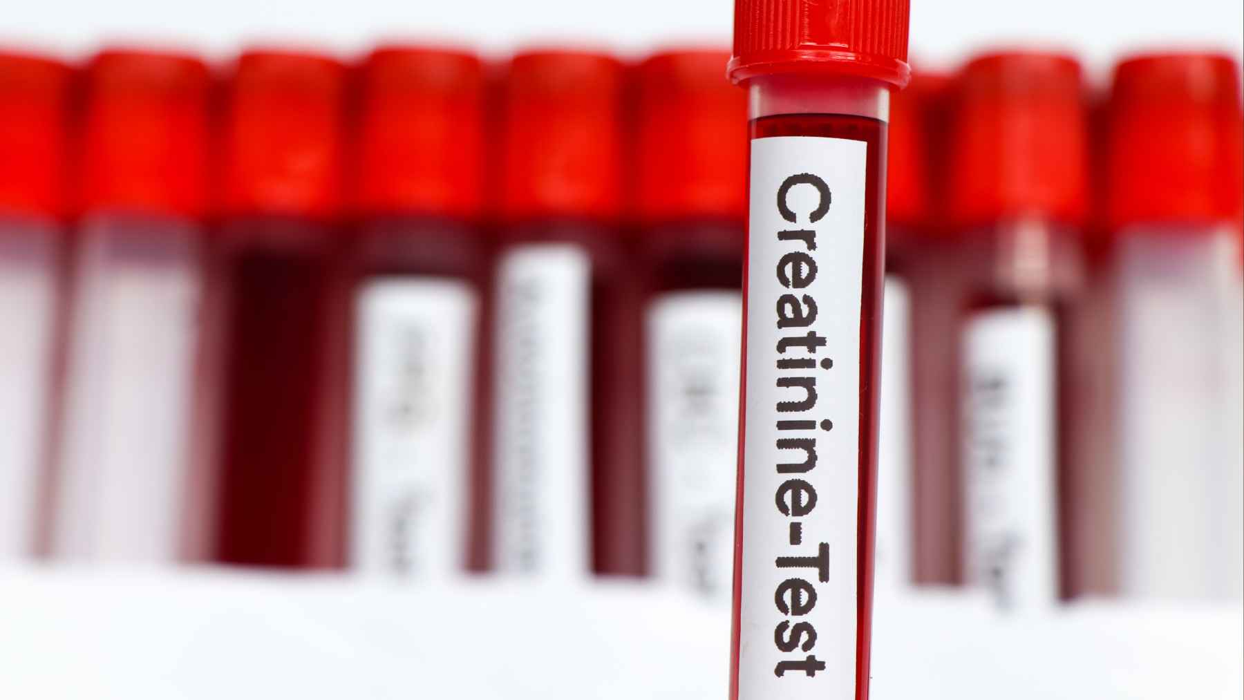 Blood sample tube labeled creatinine for a laboratory test used to assess kidney function