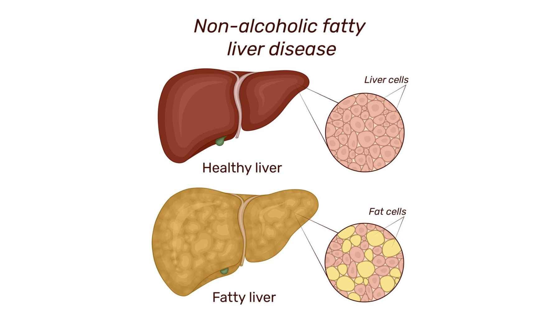 Medical diagram comparing a healthy liver with a fatty liver, showing fat accumulation inside liver cells in nonalcoholic fatty liver disease.