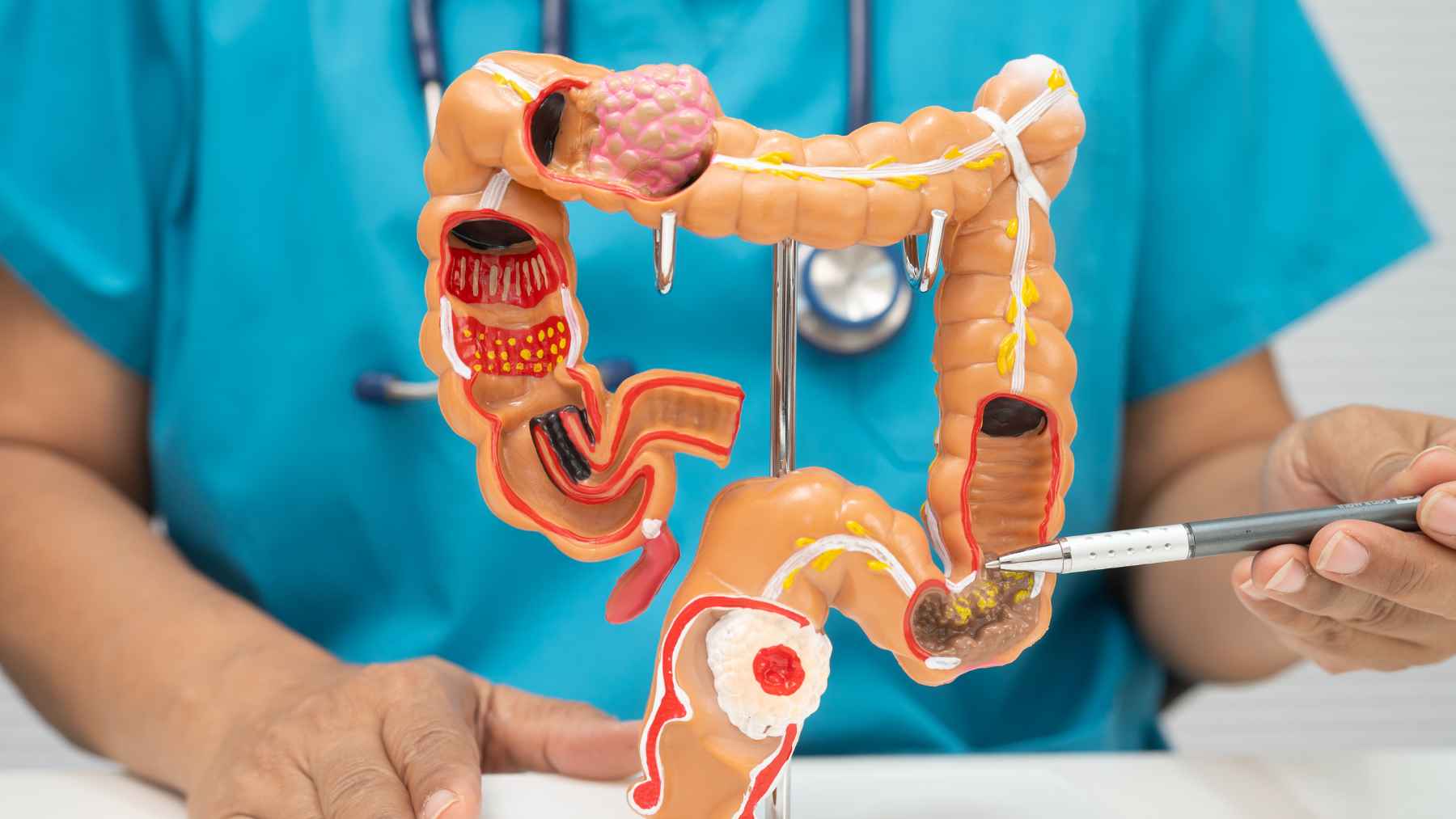Medical professional holding an anatomical model of the colon while explaining digestive health, bloating, and gut function.