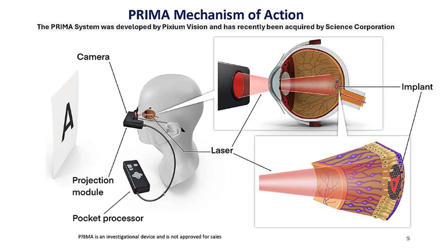 A high-tech wireless retinal implant device designed to restore central sight for patients with geographic atrophy.