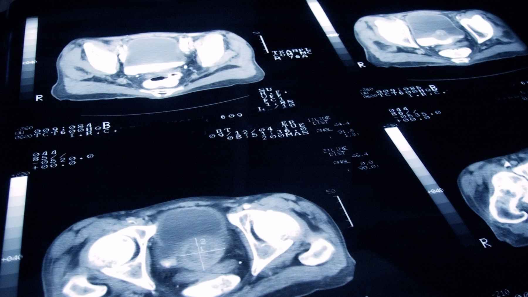 Pelvic CT scan images used to evaluate prostate cancer and monitor tumor spread in advanced disease.