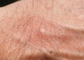 Cómo detener la picazón de las picaduras de mosquitos de inmediato este verano