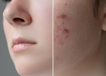 ácido azelaico para el acné