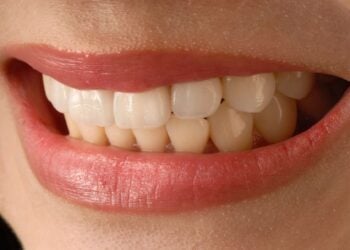 blanqueamiento dental