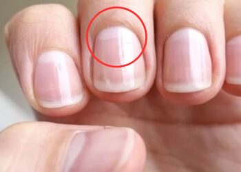 Lúnulas de las uñas, uñas, lúnulas