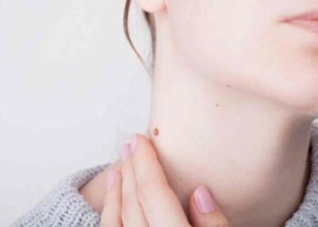 La razón por la que te salen tantas verrugas en el cuello y el truco para quitarlas en casa