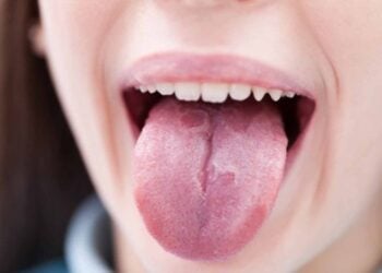 Qué significa tener la lengua blanca, según una dentista experta