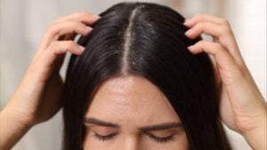 Ni champús ni químicos: dile adiós a la caspa con esta especia que ya tienes en casa