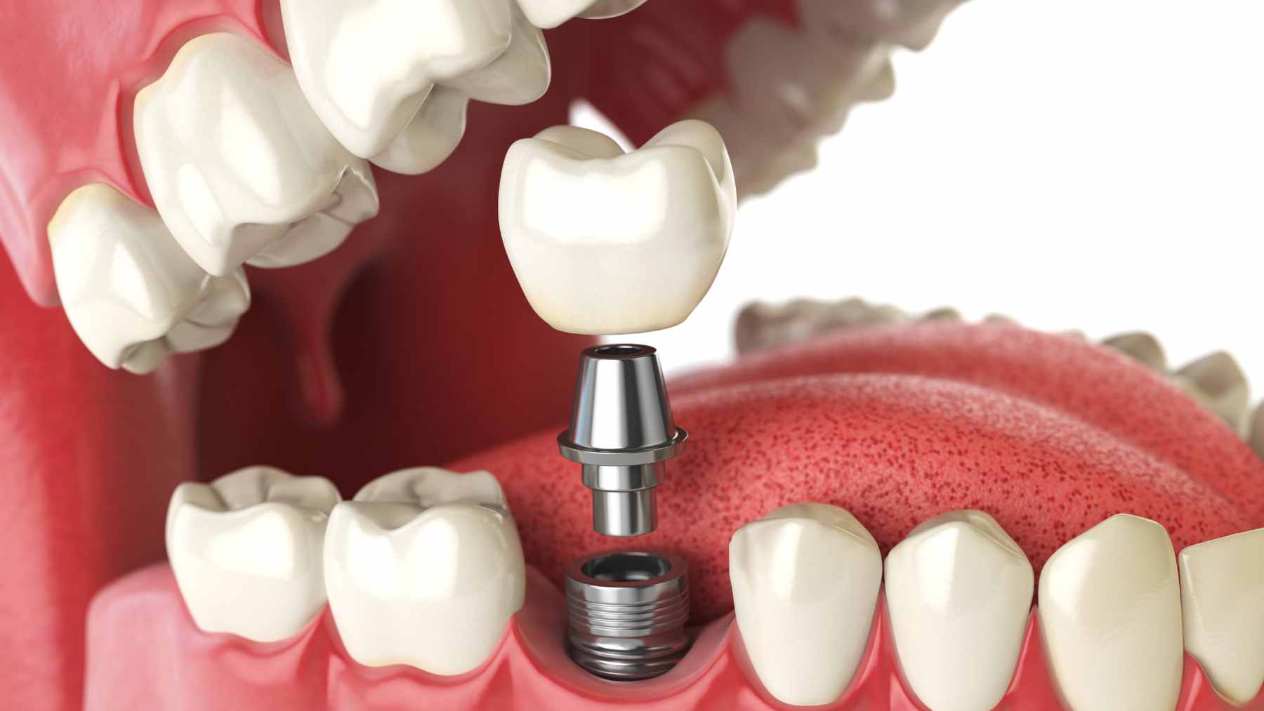 A medical illustration showing the role of the USAG-1 protein in suppressing tooth bud development and how TRG035 reactivates growth.